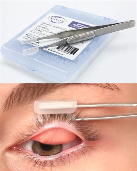 tool to measure thickness of skin on the eyleid|eyelid examination procedure.